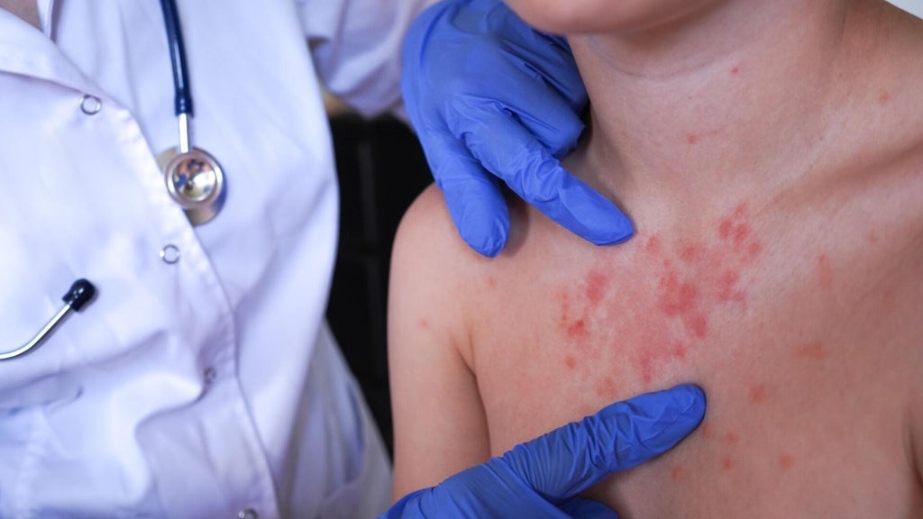Minnesota's 80 measles cases this year are the most since 1990, health officials say — Roseville Health news